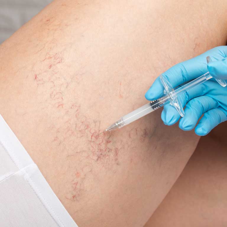 Sclerotherapy | The Riviera - Skin & Beauty Rejuvenation