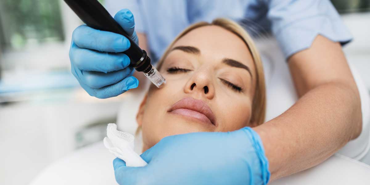 Microneedling